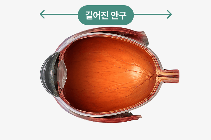 고도근시 안구
