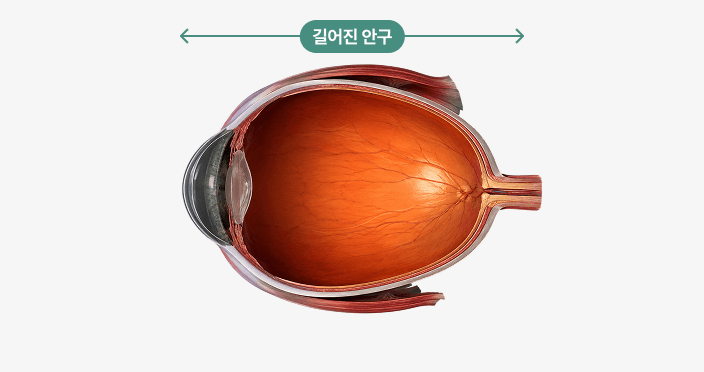 고도근시 안구