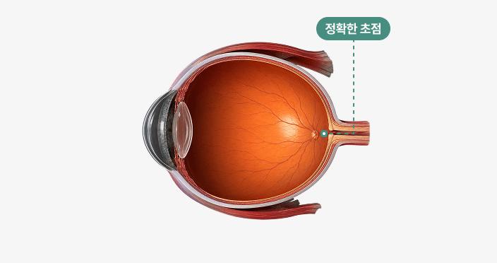 정상 안구