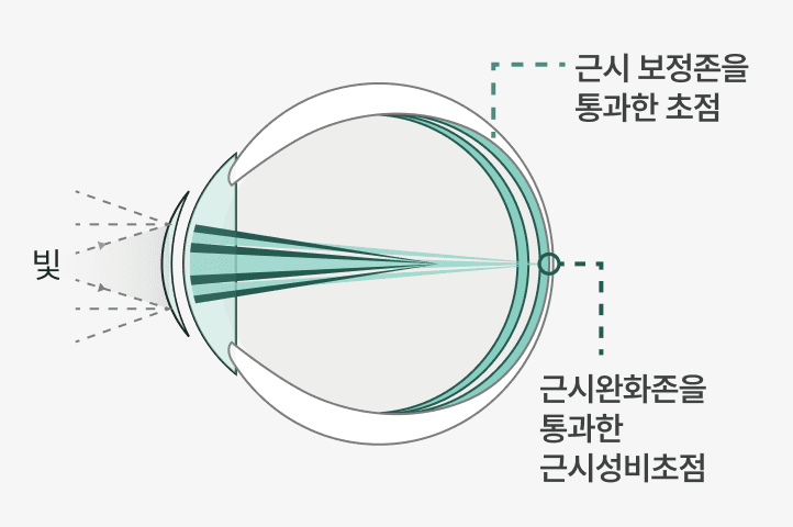 시야 단면